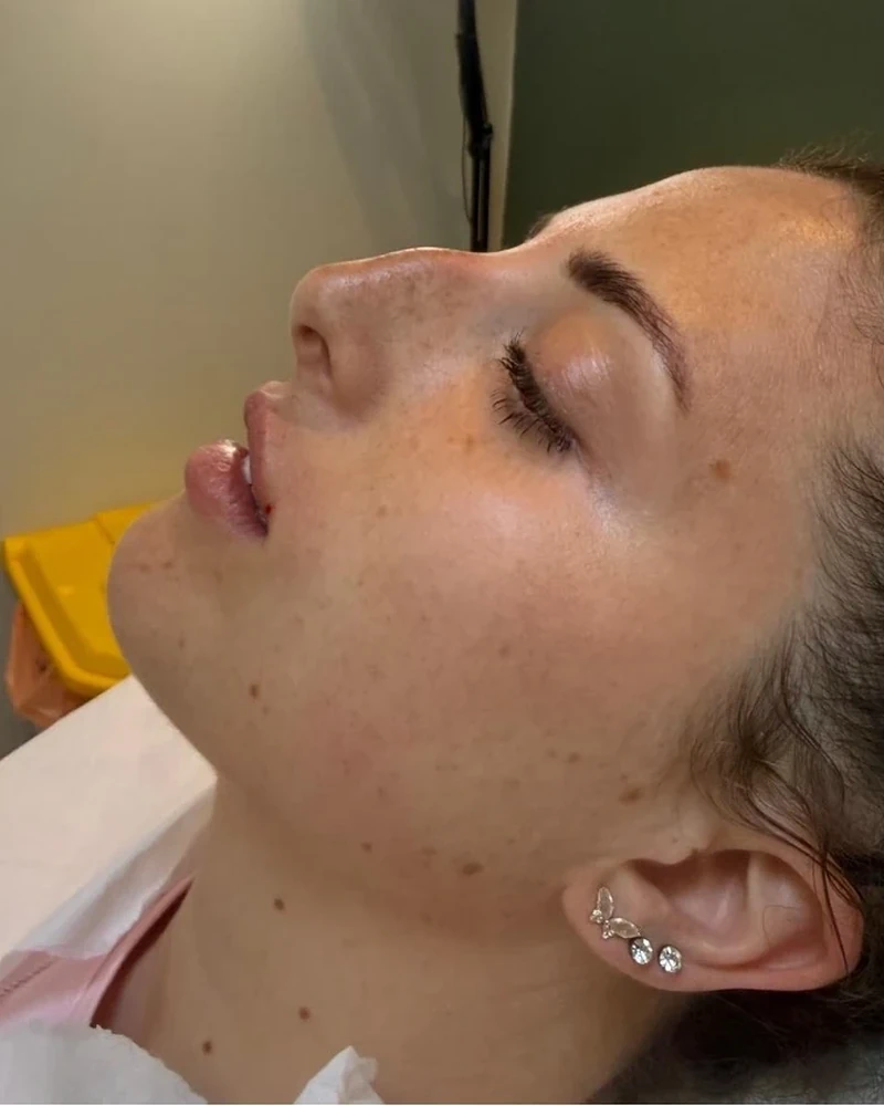 Before non-surgical rhinoplasty treatment
