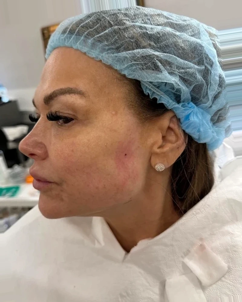 After Ultimate Facelift treatment, client result two