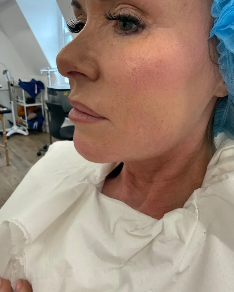 Before Ultimate Facelift treatment, clinic case 1