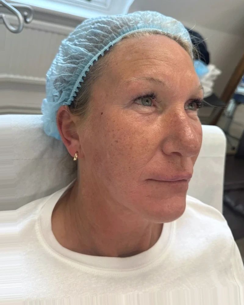 After upper facelift treatment