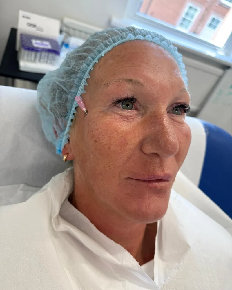 Before upper facelift treatment